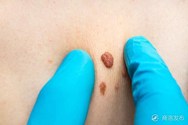 这几个症状若一同出现,是在告诉你血脂超标了